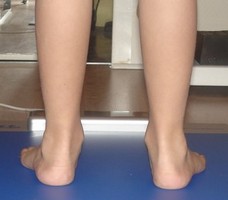 pied valgus
